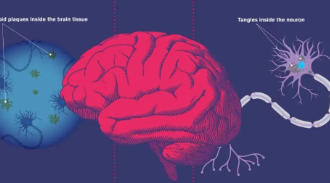 人工智能用于揭示阿尔茨海默病和其他认知障碍的细胞起源