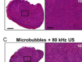 超声波和纳米气泡的结合可以在没有侵入性治疗的情况下摧毁癌性肿瘤