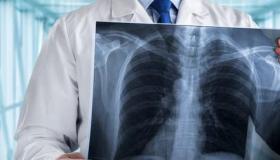 肺癌的判断 怎样排除自己不是肺癌