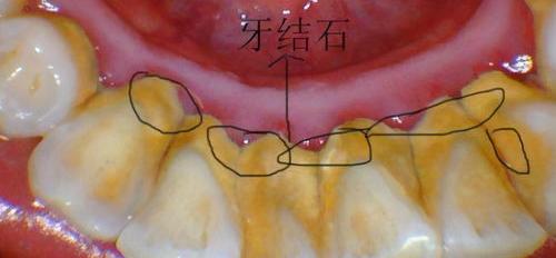 求助！狗狗得了尿结石，已经连续12天不吃东西了怎么办？ 如何让牙结石软化脱落