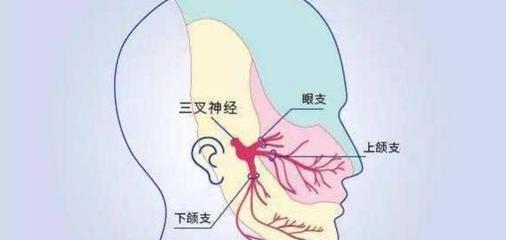 怎样缓解三叉神经痛？ 三叉神经痛