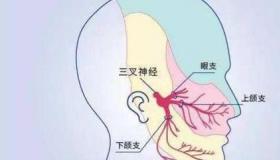 怎样缓解三叉神经痛？ 三叉神经痛