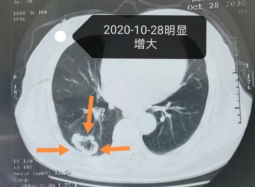 肺、癌一次化疗费用多钱？ 肺癌化疗一次多少钱