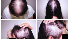 女性脂溢性脱发的治疗方法有哪些？ 女性脱发怎么调理