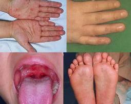 手足口病是什么样的症状？ 手足口病的症状