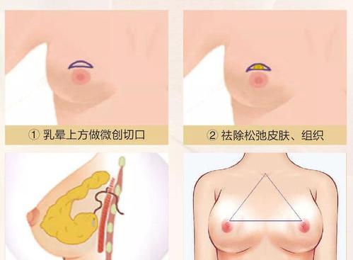 乳房干瘪下垂怎么办？ 乳房下垂矫正