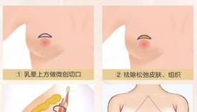 乳房干瘪下垂怎么办？ 乳房下垂矫正