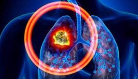 一般肺癌活多久？ 肺癌早期能活多久一般