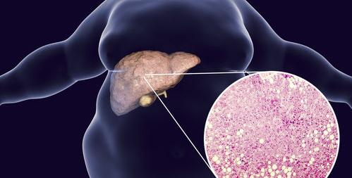 脂肪肝的最佳治疗方法是什么？ 去除脂肪肝的最佳方法