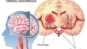 脑溢血会好吗？ 脑出血能治好吗