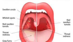 喉癌的症状是什么 咽喉癌的早期症状 喉癌的早期症状