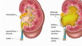 肾结石一般是什么原因引起呢？ 肾结石是什么原因造成的