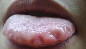 舌头根部（靠近咽喉部分）有红疙瘩是什么回事？（图为网络图片跟我一样）怎么医治 湿气太重舌头的照片