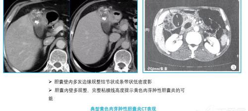 如何判断自己有胆囊炎？ 如何判断自己有胆囊炎