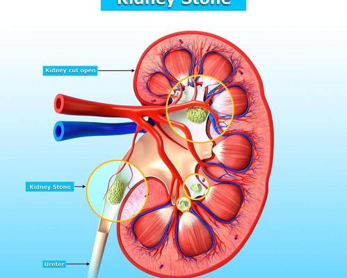 肾结石疼痛怎么缓解？ 半夜肾结石疼痛自救方法