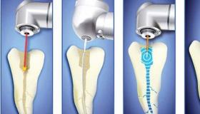 什么是牙髓炎？牙髓炎对牙齿健康有哪些危害？ 牙髓炎不治的后果
