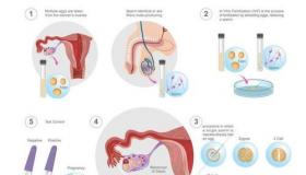 国内做试管婴儿的全部流程？ 做试管婴儿的全部流程