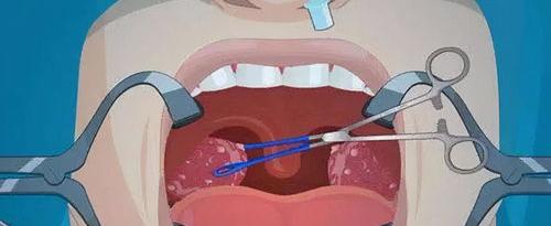 扁桃体肿大的治疗偏方 扁桃体炎偏方一天痊愈