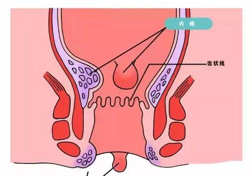 为什么怀孕会得痔疮？ 为什么会长痔疮