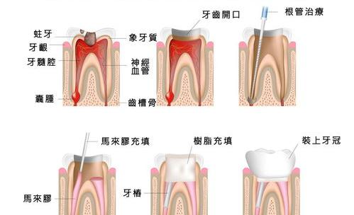 一颗牙齿根管治疗大概需要多少钱？ 根管治疗一颗牙多少钱