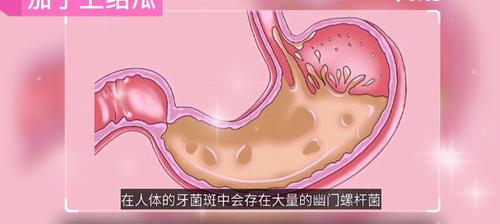 幽门螺杆菌是什么？它会传染给其他人吗？ 幽门螺旋杆菌传染吗