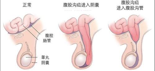 疝气是什么症状啊？ 疝气的症状