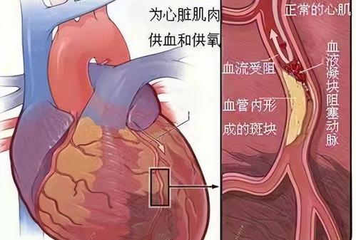 心梗的最好治疗方法 心肌梗塞最佳治疗方法