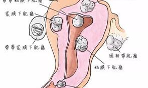 子宫肌瘤癌变的症状？ 子宫肌瘤癌变的10个征兆