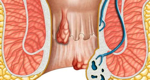 初期痔疮是什么样的 痔疮刚开始长啥样