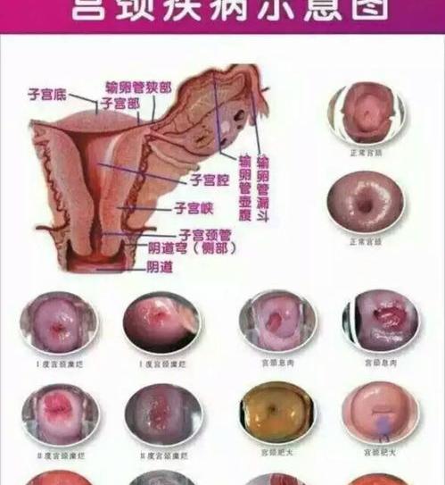 子宫糜烂2度用什么药能好？ 宫颈糜烂2度能自愈吗