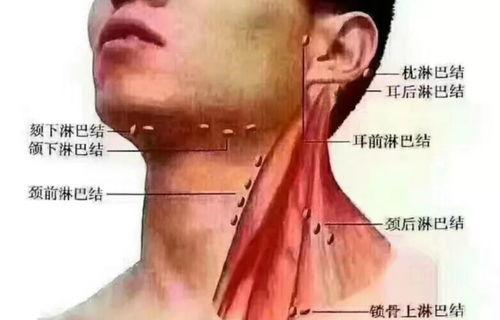 淋巴癌早期的症状有什么？ 淋巴早期的10个征兆