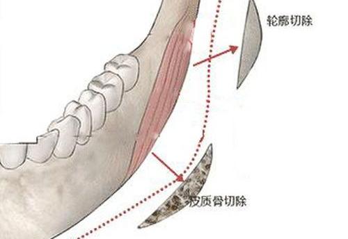 削骨危险吗 削骨手术死亡率大吗