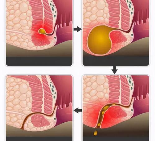 肛瘘是什么引起的，不治会是什么后果？ 肛瘘不治疗有什么后果