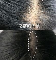 肾虚脱发可以再生吗？ 肾虚脱发能自己恢复吗