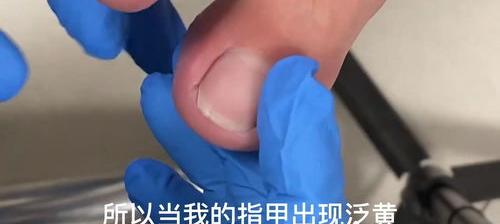 甲沟炎是怎样引起的？ 甲沟炎是怎么引起的