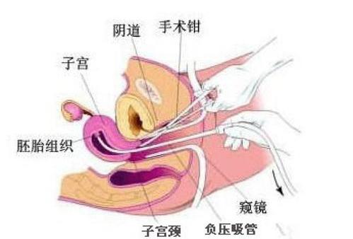 做无痛人流的最佳时间是什么时候？ 无痛人流打胎最佳时间