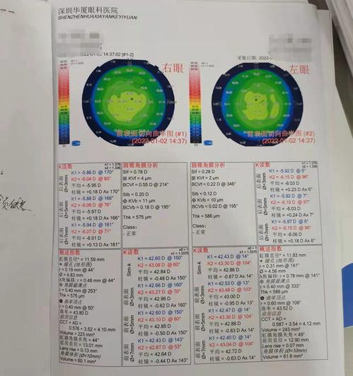 德国蔡司全飞秒手术多少钱？ 激光近视手术的价格表