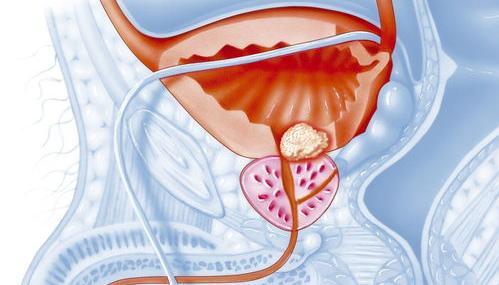 前列腺癌的症状都有哪些呢？ 前列腺癌症状有哪些