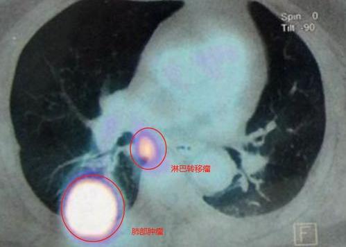 肺癌晚期的6种治疗偏方有效实用 我用偏方治好了肺癌