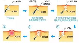 毛囊角化症，就像鸡皮疙瘩，能治好吗？ 毛周角化症能自愈吗