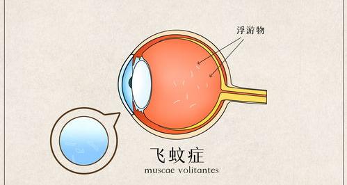 飞蚊症能自己恢复吗？ 飞蚊症怎么治疗恢复