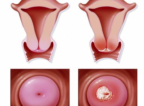 宫颈癌的早期症状是什么？这种疾病该如何自查？ 宫颈癌身体有啥反应