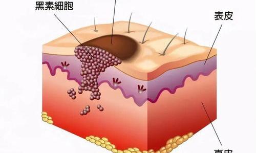 我的姐姐的黑色素癌，因为瘤破了才发现，请问会不会是晚期，能活多久 黑色素瘤得了5年才知道