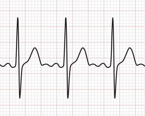 心律失常怎么治最好？ 心律失常