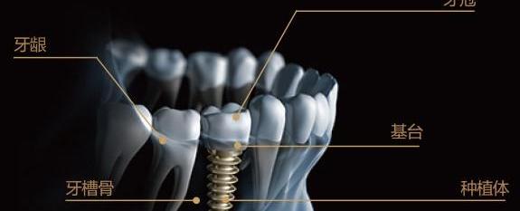 种植牙使用寿命是多少年呢？ 种植牙10多年感受