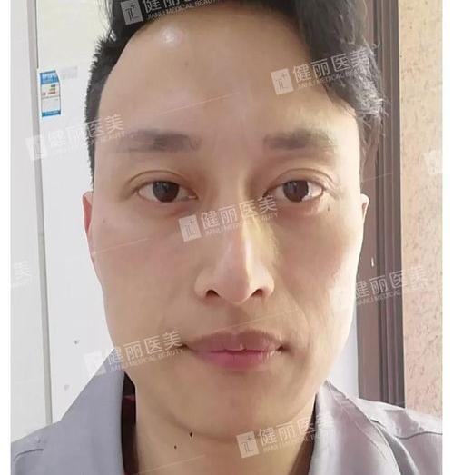 男人眼袋怎么消除？ 男人眼袋大怎么消除