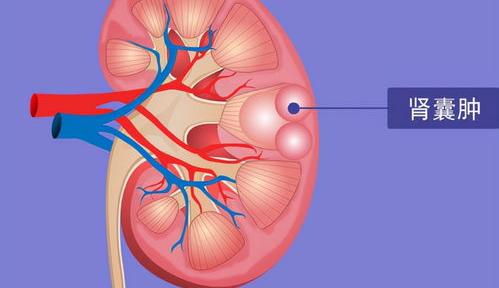 肾囊肿做手术多少钱？ 肾囊肿多大cm需要手术