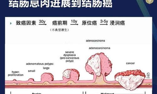 癌症前期可以控制吗 ？ 总是放响屁是癌症前期