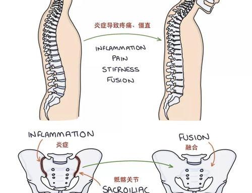 髋关节运动时用手摸有格格的感觉 不要嫁给强直性脊柱炎