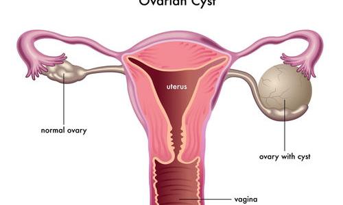 卵巢囊肿怎么治疗？ 卵巢囊肿怎么治疗